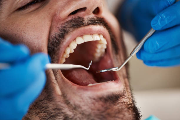 Best Emergency Tooth Extraction in Old Stine, CA